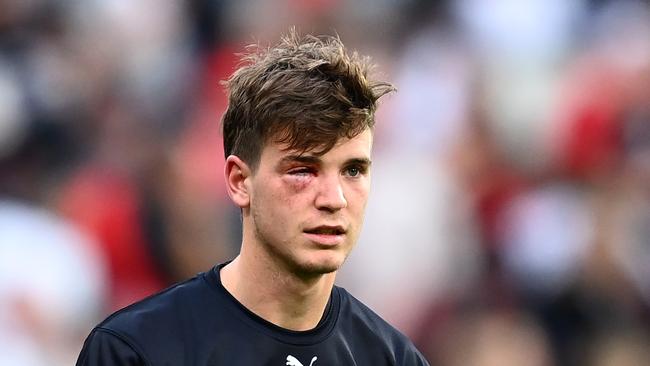 Paddy Dow was subbed out with this shiner. Picture: Quinn Rooney/Getty Images