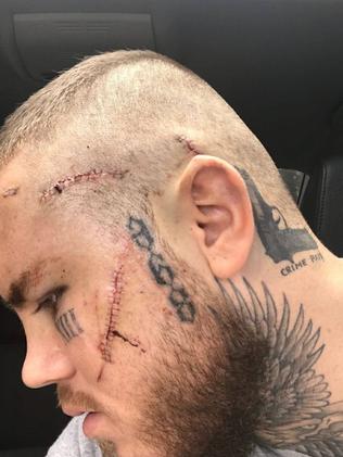 Photo of facial stitches and ‘crime pays’ tattoo.