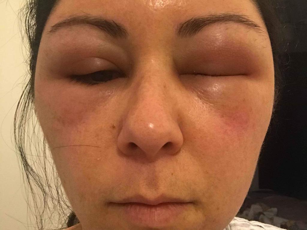 Womans Head Swells Like A Balloon After Shocking Allergic Reaction To