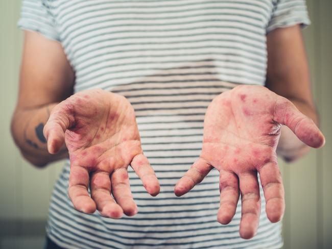 Measles, hand foot and mouth disease, istock