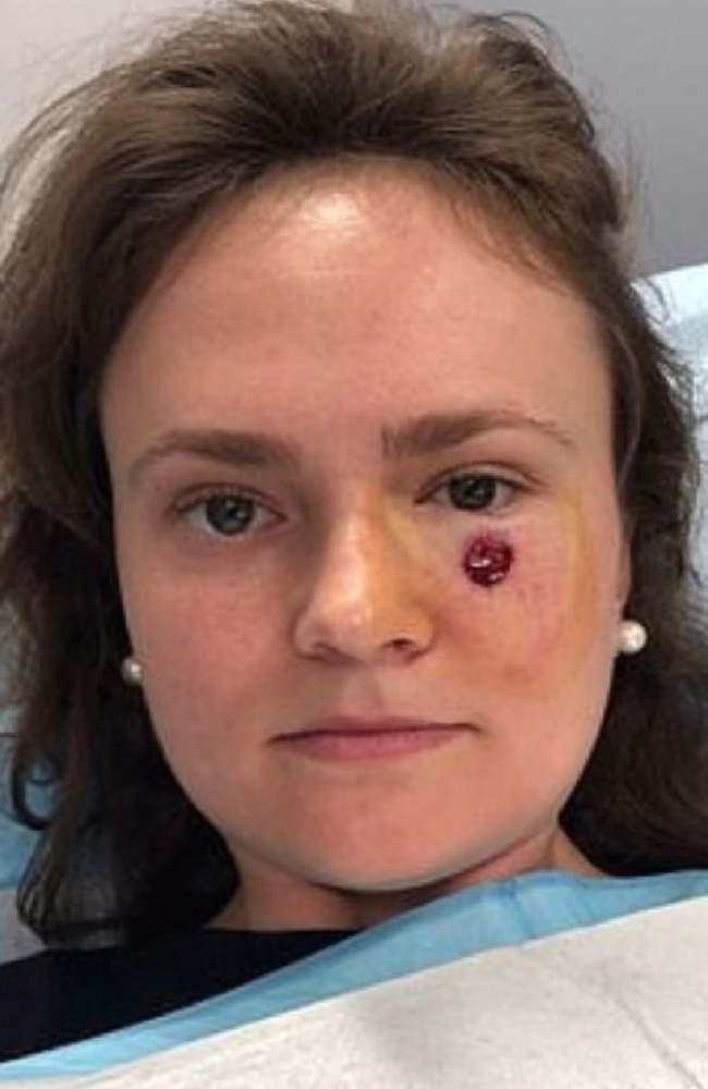 Gibson Miller, 24, from New York, thought a small mark under her eye was a blemish. Picture: Mount Sinai Hospital