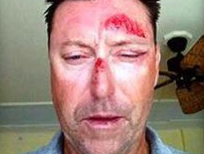 Robert Allenby was left with horrific injuries.