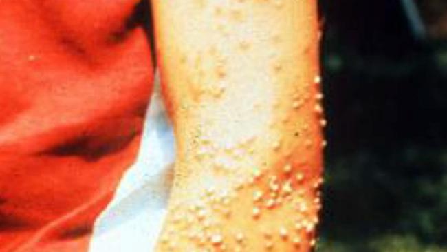 A fire ant victim from the United States.