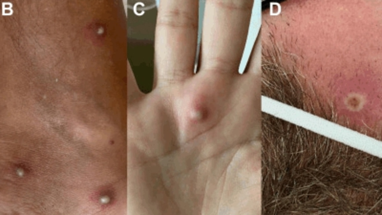 Some of the lesions the man presented doctors with. Picture: Journal of Infection.