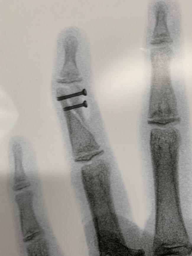 X-ray of Nickola McNabb with her crooked finger after the operation with the Field Micro Screws in place.