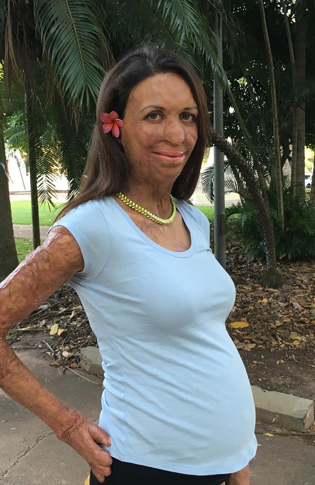 Turia Pitt on pregnancy: ‘I’ll get a baby from the pain’ | news.com.au ...