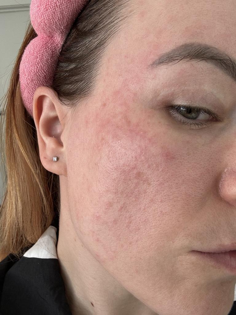 I’d inadvertently damaged my skin barrier. Big oops. Picture: Supplied/RebekahScanlan