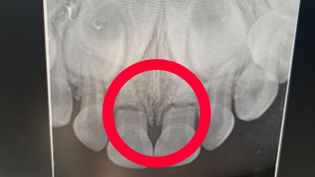 The horizontal black lines within the circle indicate fractures. Source: Supplied