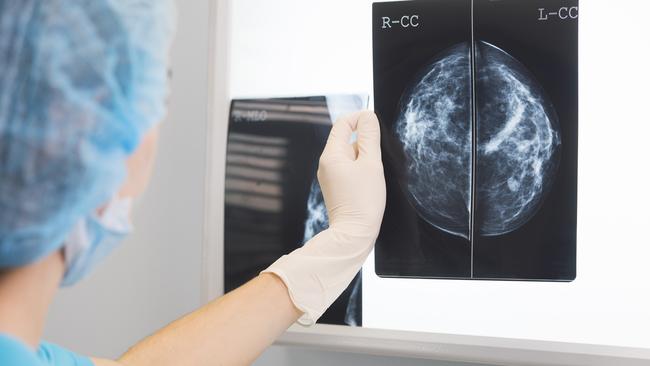 Volpara has more than 90 million mammograms stored in the cloud.