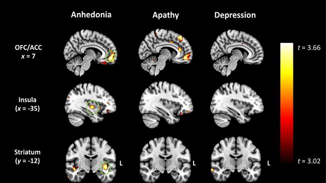 Scans reveal anhedonia in frontotemporal dementia related to degeneration of grey matter in the brain’s pleasure regions. Credit: University of Sydney