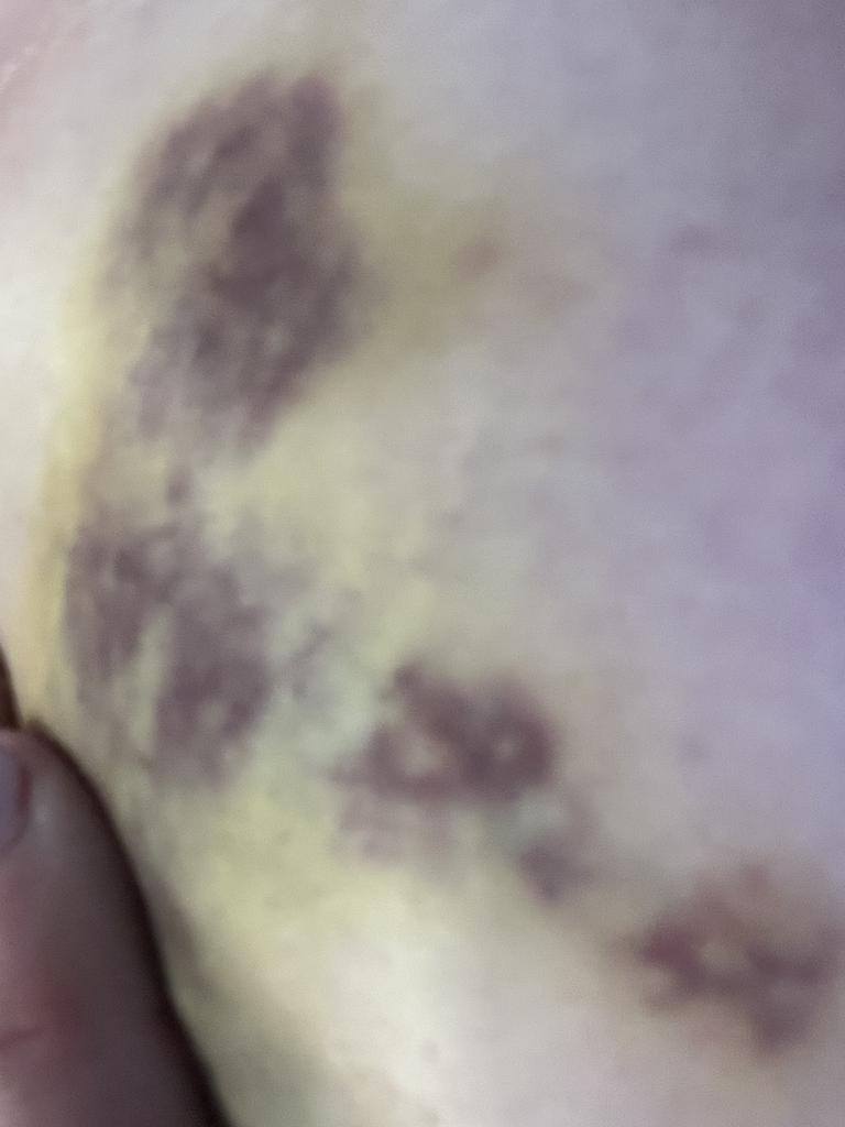 One of the injuries sustained by Phebe Furneaux. Picture: Supplied