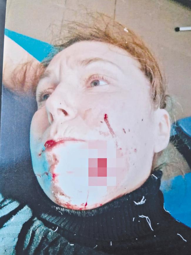 Oksana Serhiienko was shot in the face by Russian troops. Supplied