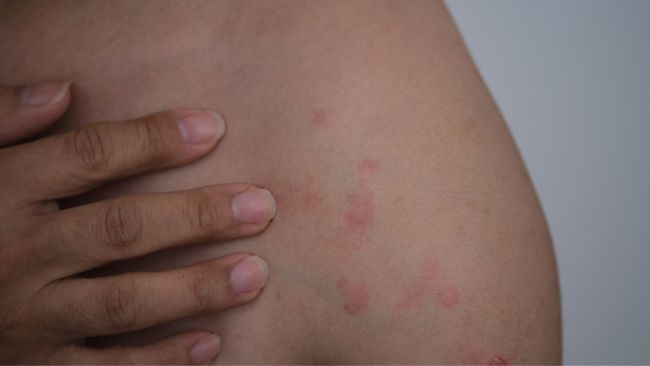 What is PUPPP? Common pregnancy rash explained
