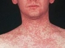 A typical measles rash. Picture: Victoria Department of Health