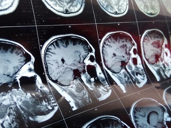 Magnetic resonance scan of the brain with skull. MRI head scan on dark background blue color. X-ray medicine and medication concept