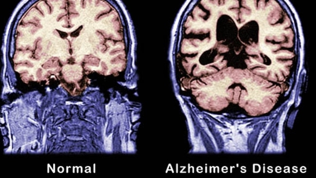 A brain scan showing the effects of Alzheimer’s disease.