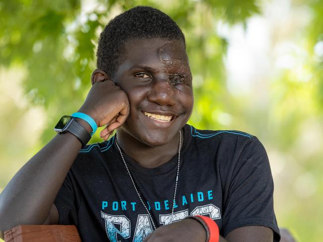 Victor Ramei, 14 after his surgery in Adelaide to remove his left eye and a tumor he had since birth at the Melbourne-based Children First Foundation. Isaac Oliver is his cousin and came to Australia to support him and be his interpreter. Picture: Jason Edwards