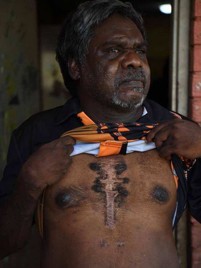 Chadwick Koimala has had multiple heart surgeries since he was diagnosed with rheumatic fever as a child. Picture: (A)manda Parkinson