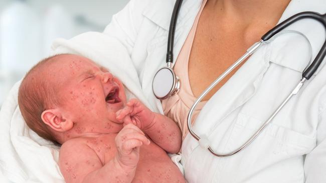 A newborn baby with measles. Picture: istock