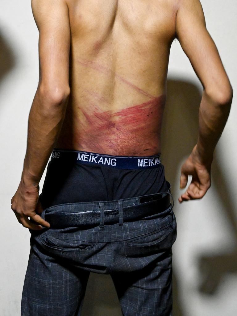 Taqi Daryabi shows injuries on his back. Picture: Wakil Kohsar/AFP