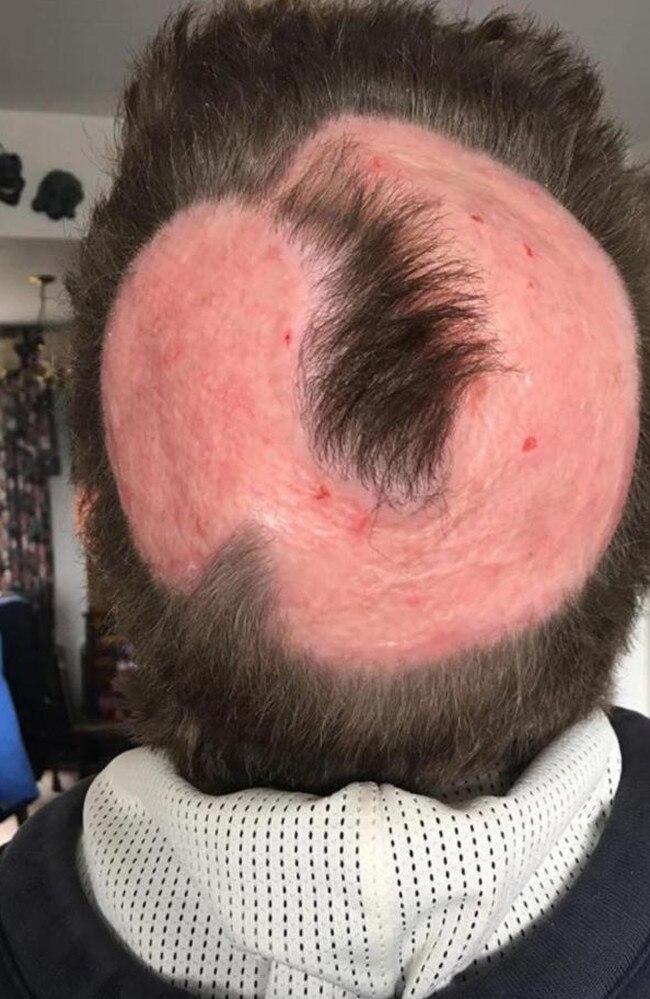 Unfortunately Kirsty has been told that her hair won't grow back as there are no follicles in the skin grafted from her thigh. Picture: PA/Real Life