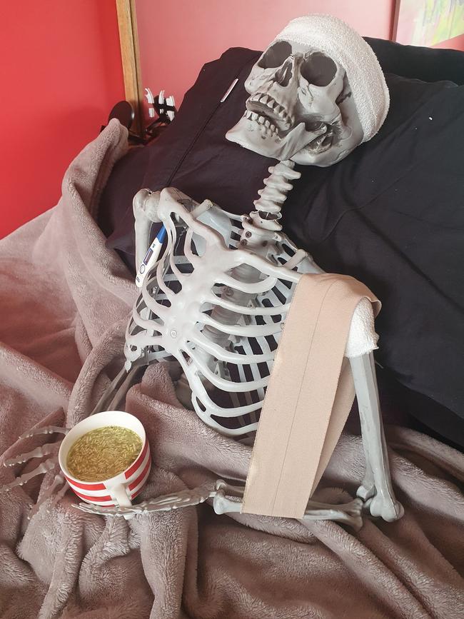 Murray the South East Skeleton underwent emergency surgery on Sunday night after he was viciously dismembered by vandals. Picture: Supplied