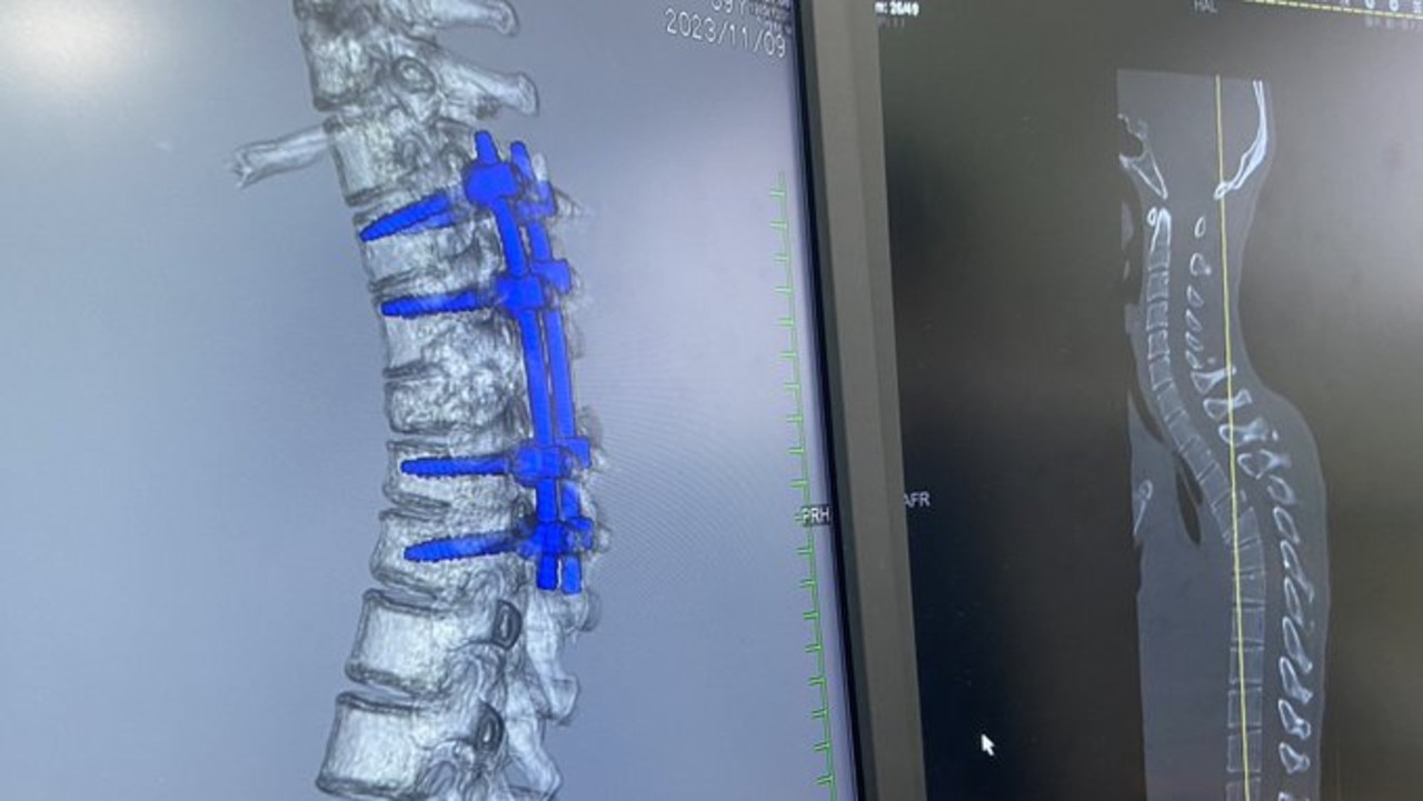 X-rays show the damage sustained by Joe Fujii's spine. Picture: X @joefujii1