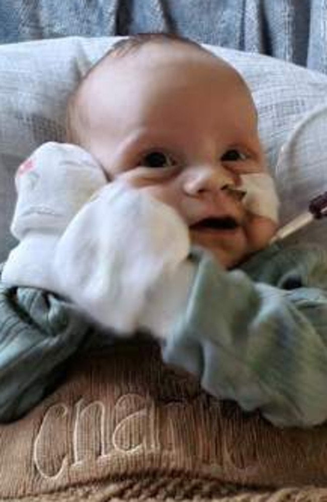 Sunshine Coast baby Charlie Dunn born with his intestines outside of his body. Picture – contributed.