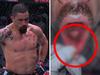 ‘OMG’: Aussie UFC star has jaw shattered
