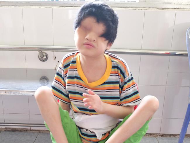 Tran Huynh Thuong Sinh, aged 13, with Fraser Syndrome — a rare genetic disorder characterised (as in Tran’s case) with partial webbing of the fingers and/or toes, kidney abnormalities, genital malformations and complete fusion of the eyelids. Photo: Ash Anand / NEWSMODO