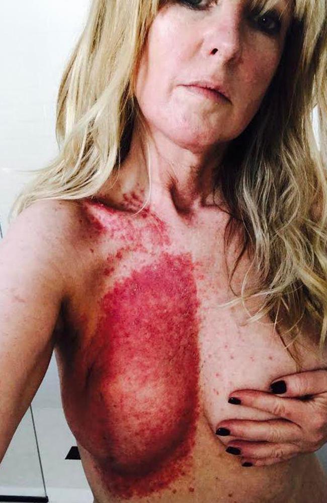 Breast cancer treatment: Woman suffers horrific burns during radiation