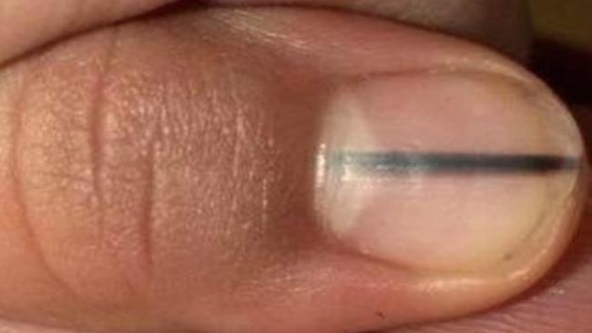 Nail Salon Visit Leads To Cancer Diagnosis For Woman With Black Line On
