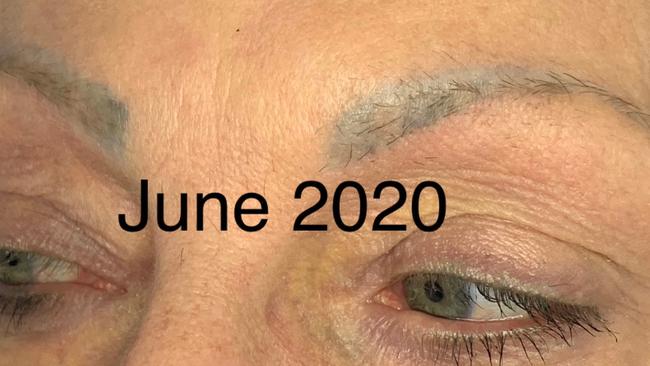 An example pigment removal of tattooed eyebrows.