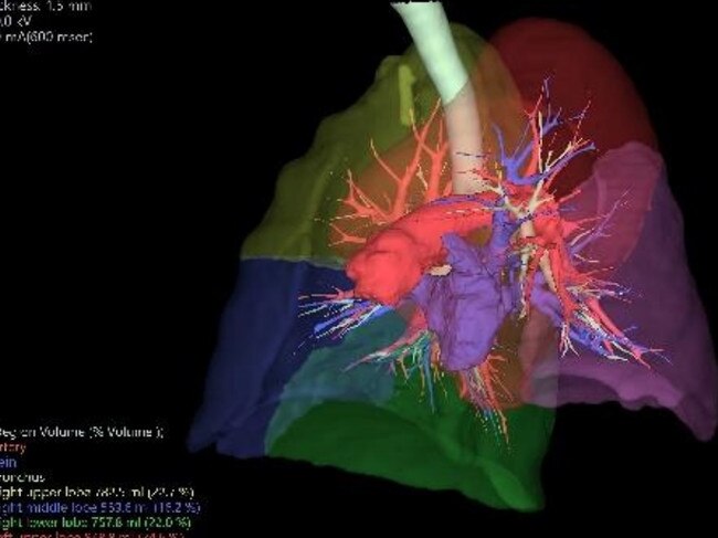 Doctors in the US conducted tests that determined part of Mr Cheng's left lung had been removed.