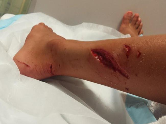 Facebook image of Kirra-belle Olsson after she was attacked by a shark at Avoca Beach. Picture: Facebook