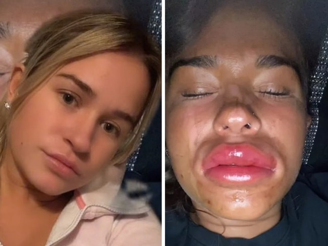 ‘Horrid’ reaction after lip filler mistake