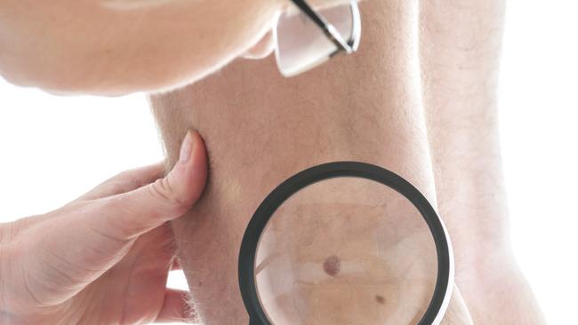 Dermatologist examines a mole of male patient