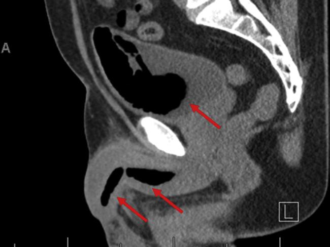 A man will likely never have sex again after his partner accidentally released weatherproofing spray foam into his penis in a bizarre attempt to treat his impotence. Picture: Urology Case Reports