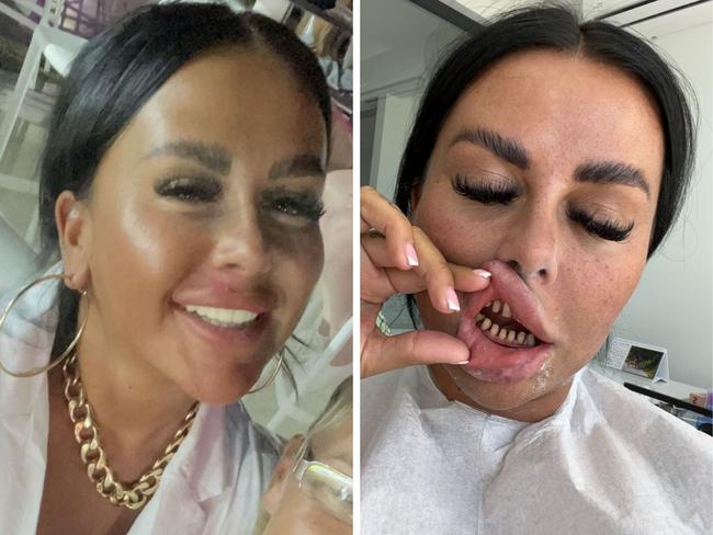 Couple's nightmare veneer ordeal. Picture: SWNS