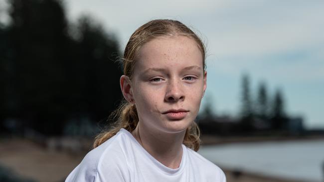 Lizzie Wingrove, 12, four years after she was attacked by a dog in her own street. Lizzie is still undergoing plastic surgery to minimise the scaring. PICTURE: Brad Fleet