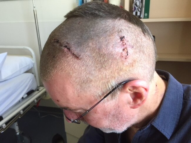Geoff Wilkinson after his Deep Brain Stimulation surgery.