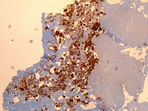 Q fever or query fever is a disease caused by infection with Coxiella burnetii,a bacterium that affects humans and other animals. This organism is uncommon, but may be found in cattle, sheep, goats, and other domestic mammals, including cats and dogs.  Immunohistochemical detection of C. burnetii in resected cardiac valve of a 60-year-old man with Q fever endocarditis, Cayenne, French Guiana. Picture: Wikipedia