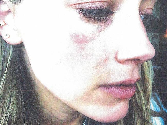 Bruising on Amber Heard's face she claims was inflicted by Johnny Depp. Picture: Splash News