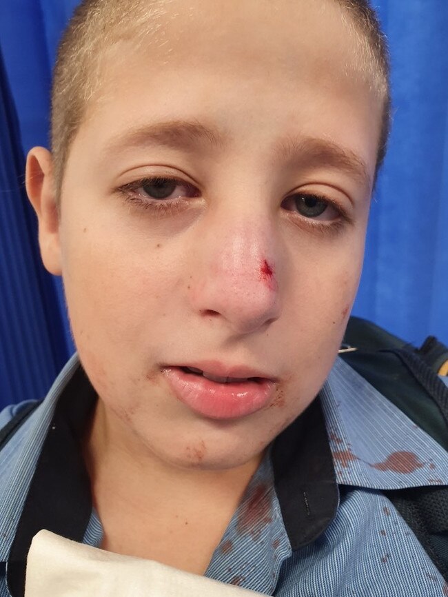 Forest Lake State High School student Arthur Carstens allegedly had his nose broken by another student at the school. PICTURE: Supplied