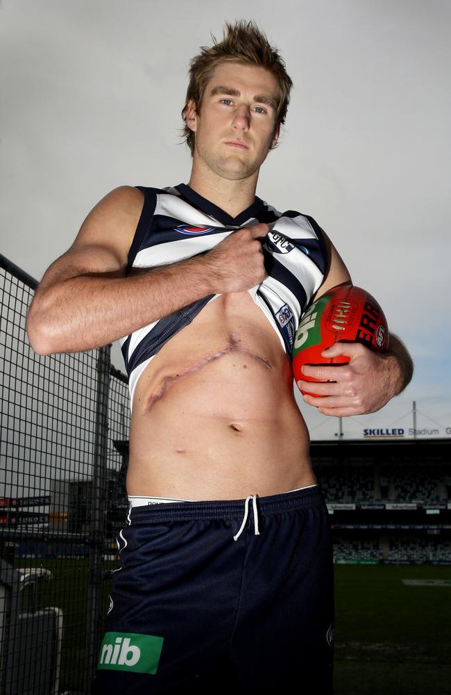 The scars on Tom Lonergan’s body following lifesaving surgery. Picture: Colleen Petch