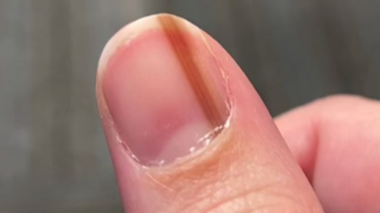 Finger nail streak: Symptom of skin cancer Subungual melanoma   — Australia's leading news site