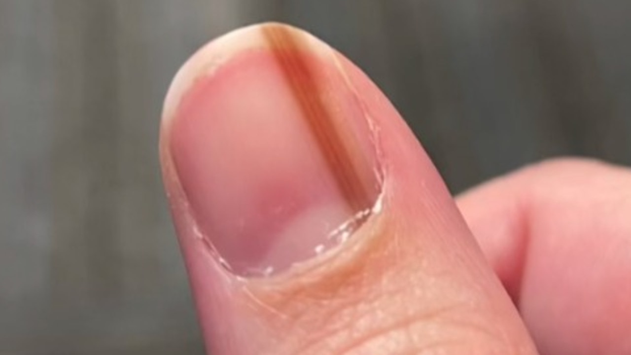 finger-nail-streak-symptom-of-skin-cancer-subungual-melanoma-news