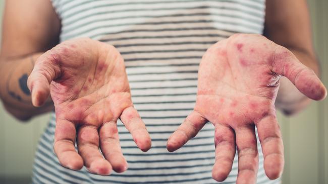 Measles, hand foot and mouth disease, istock