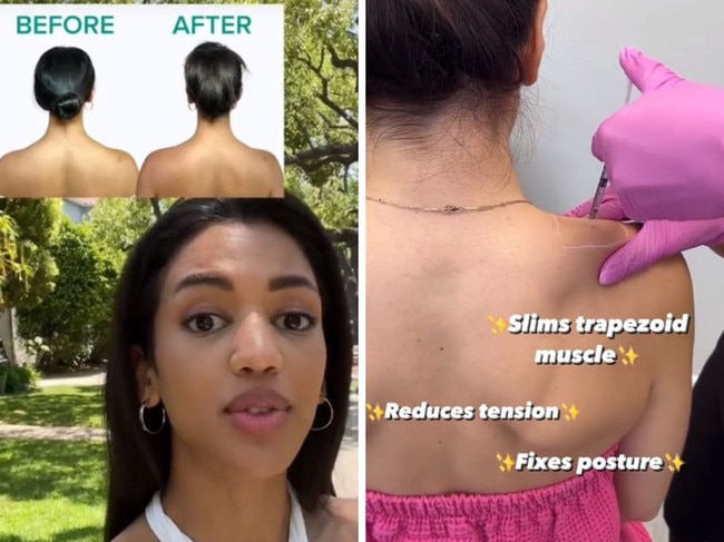 Inside the Barbie Botox trend. Picture: TikTok