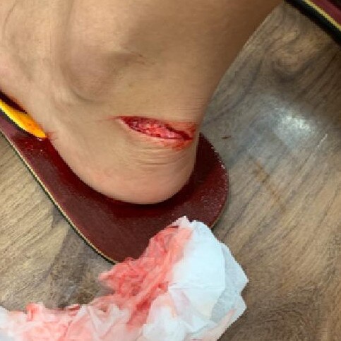 The injury to Toby’s heel, which sliced his Achilles tendon, was surgically repaired the same day. He claims he has ongoing issues as a result of the injury.